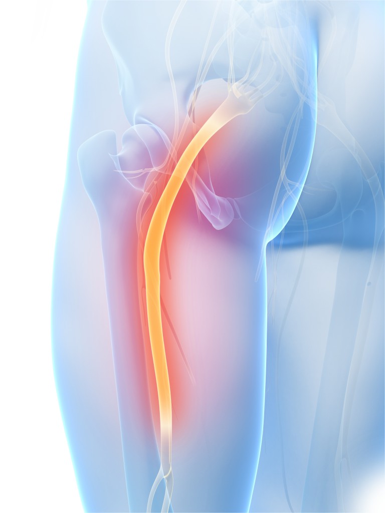 sciatica illustration